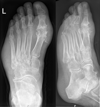 diptych of two x-rays of a foot from different angles showing swelling in the joint along the big toe