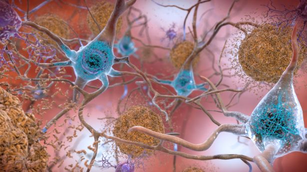 The Alzheimer's disease brain, with build ups of tau protein on the inside and beta amyloid protein on the outside