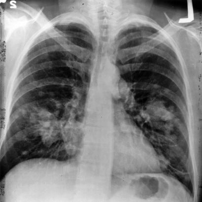 Chest x-ray, showing a possible lung cancer tumor. 