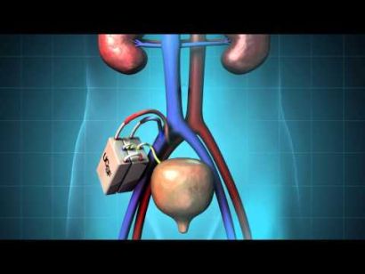 Diagram of artificial kidney device implanted within the body.