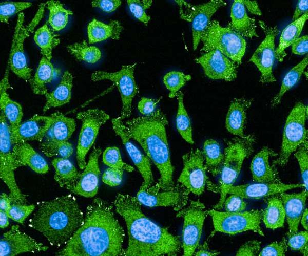 lung cancer cells before treatment